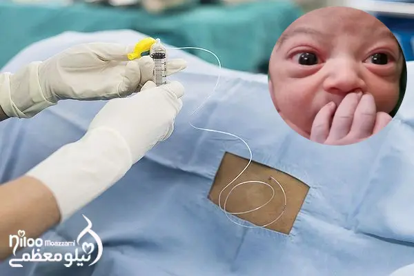 زایمان با اسپاینال