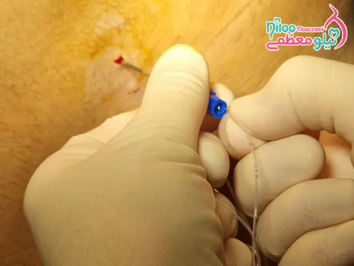 زایمان با اپیدورال