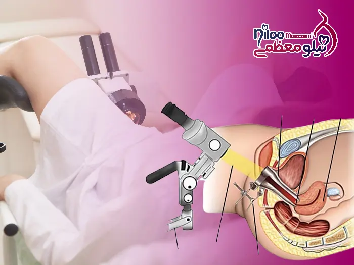 کولپوسکوپی