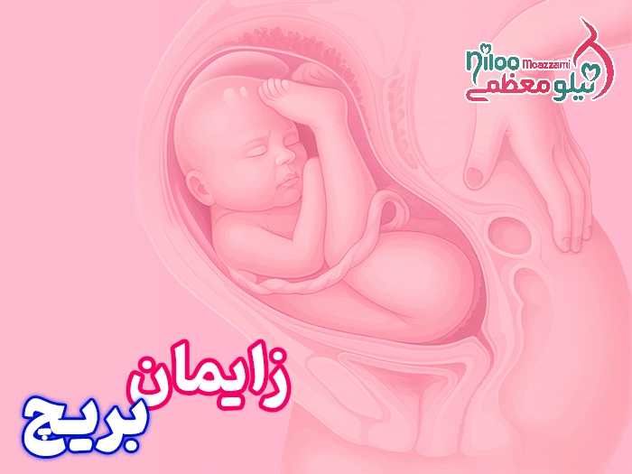 زایمان بریچ چیست