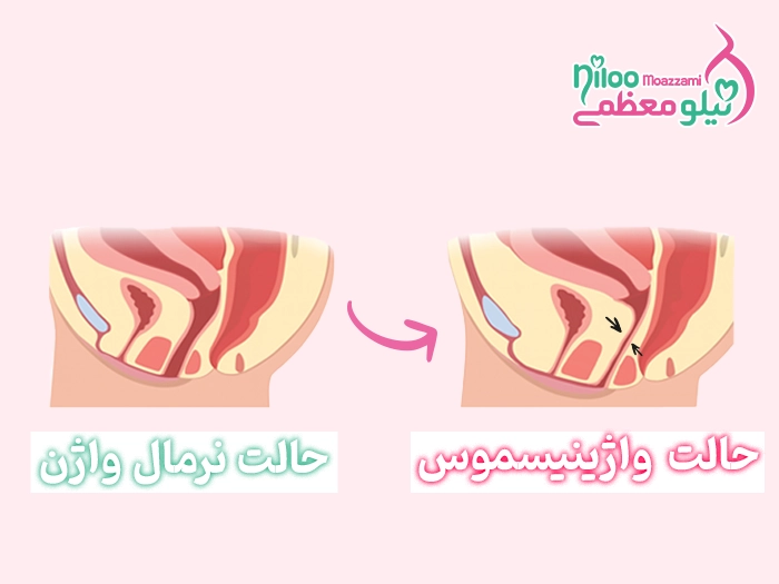 واژینیسموس