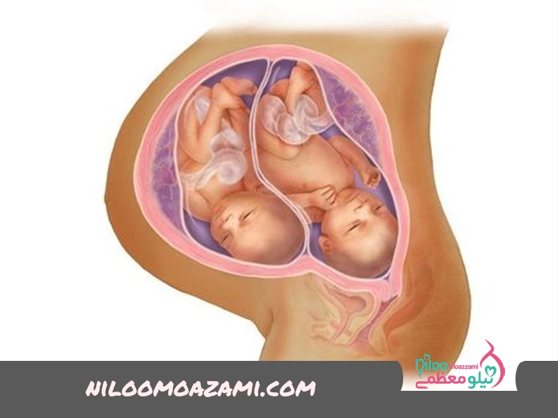 زایمان دوقلو